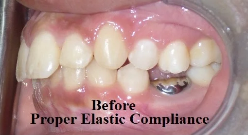 Before - Non-compliant elastic wear