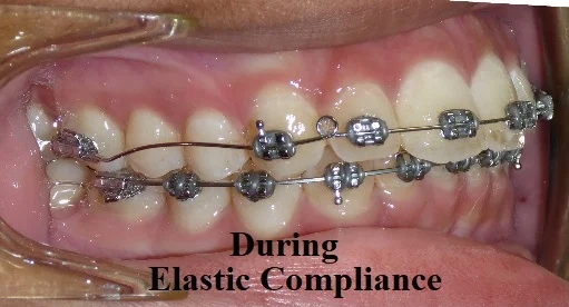During - Wearing elastics properly