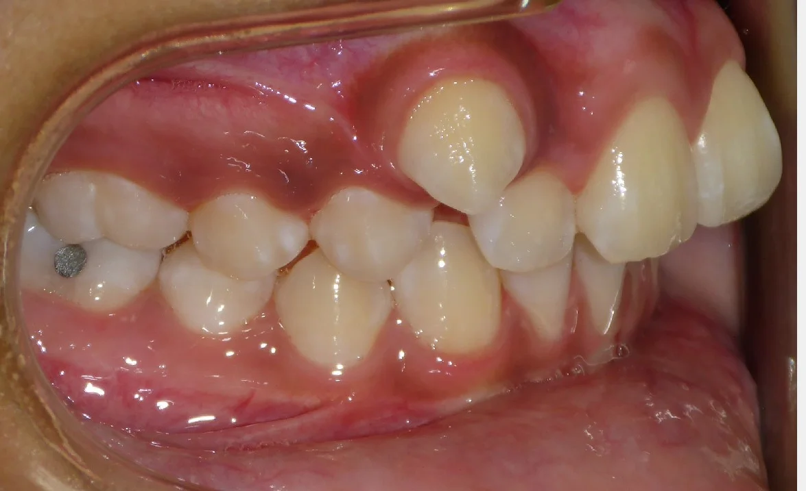 Before braces treatment