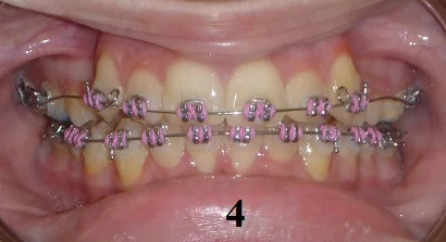 TipEdge Braces - Step 4