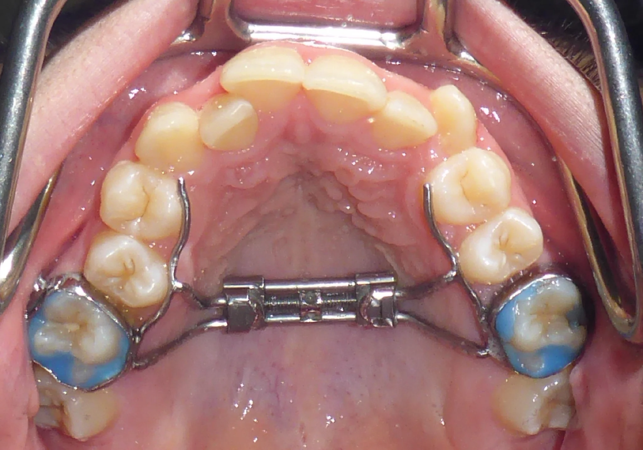 Palate Expander