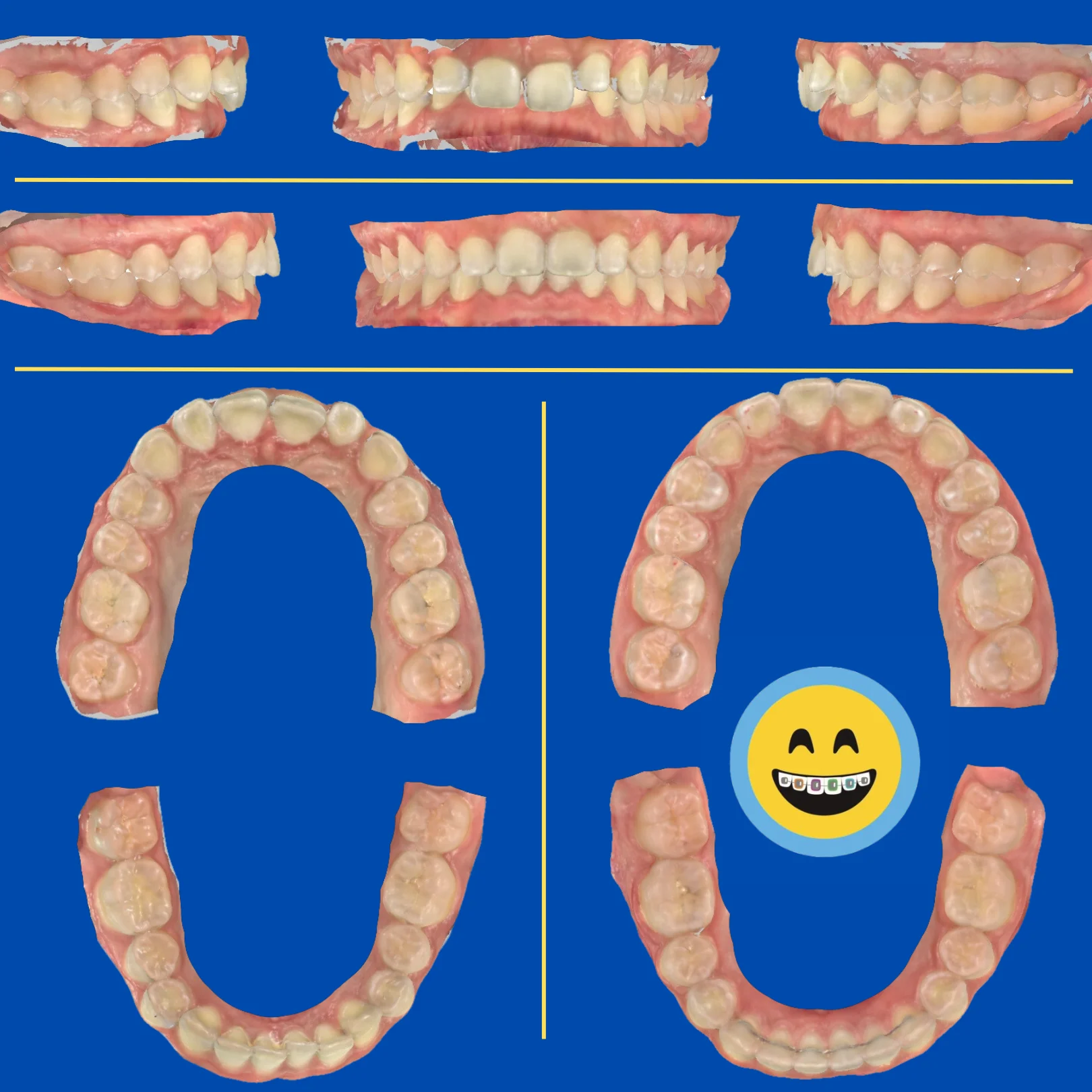 Elani - Before and After