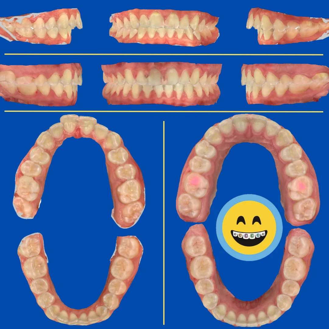 Emma - Before and After