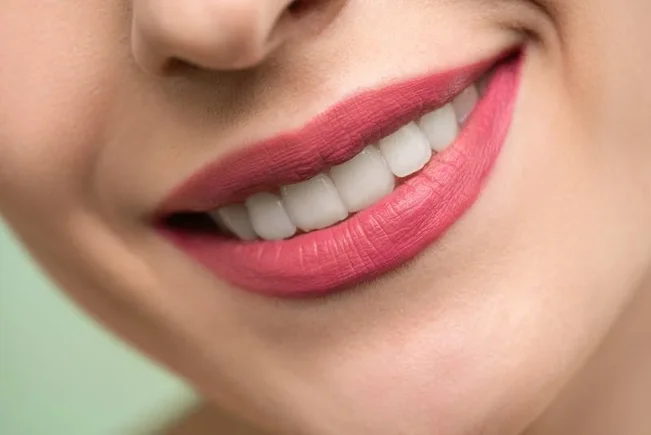 Beautiful straight smile - Results you can achieve at Smile Today Orthodontics
