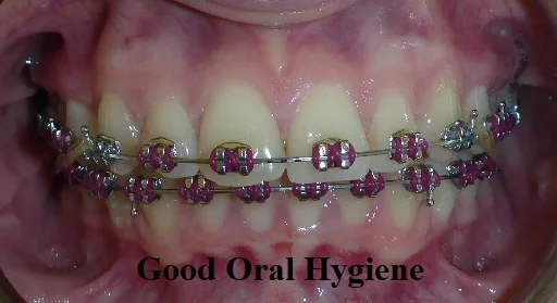 Good oral hygiene with braces