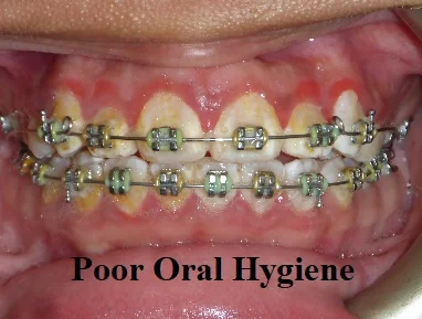Poor oral hygiene with braces