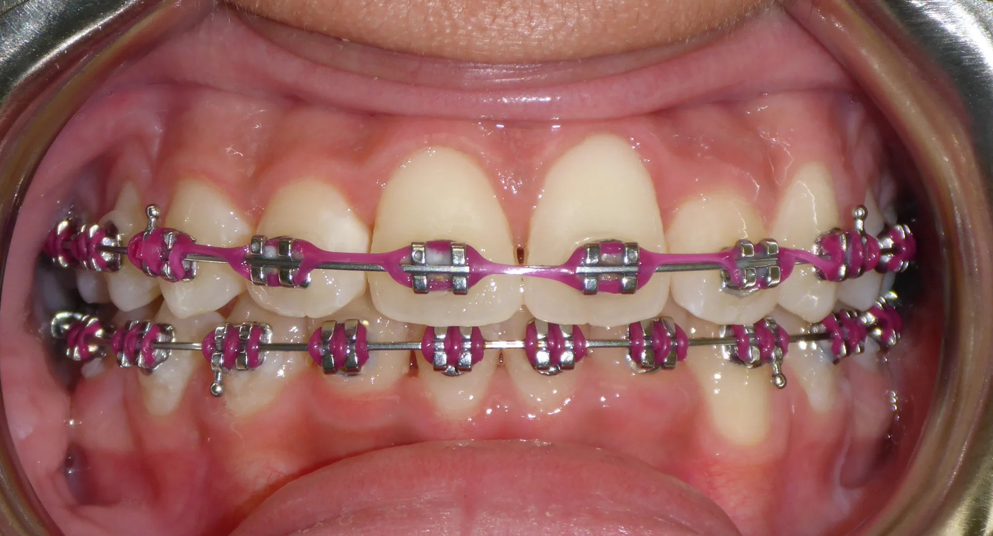 Traditional metal braces