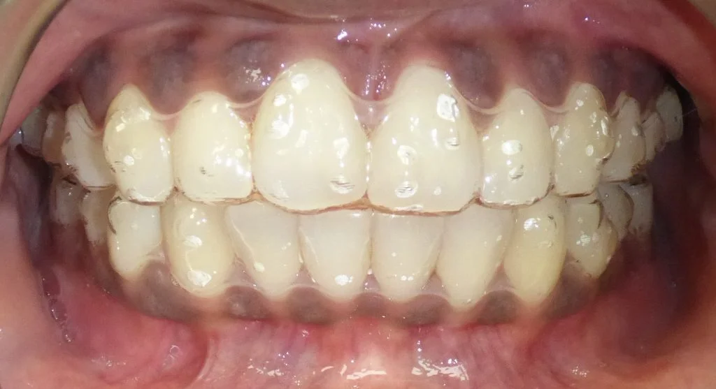 Invisalign clear aligners
