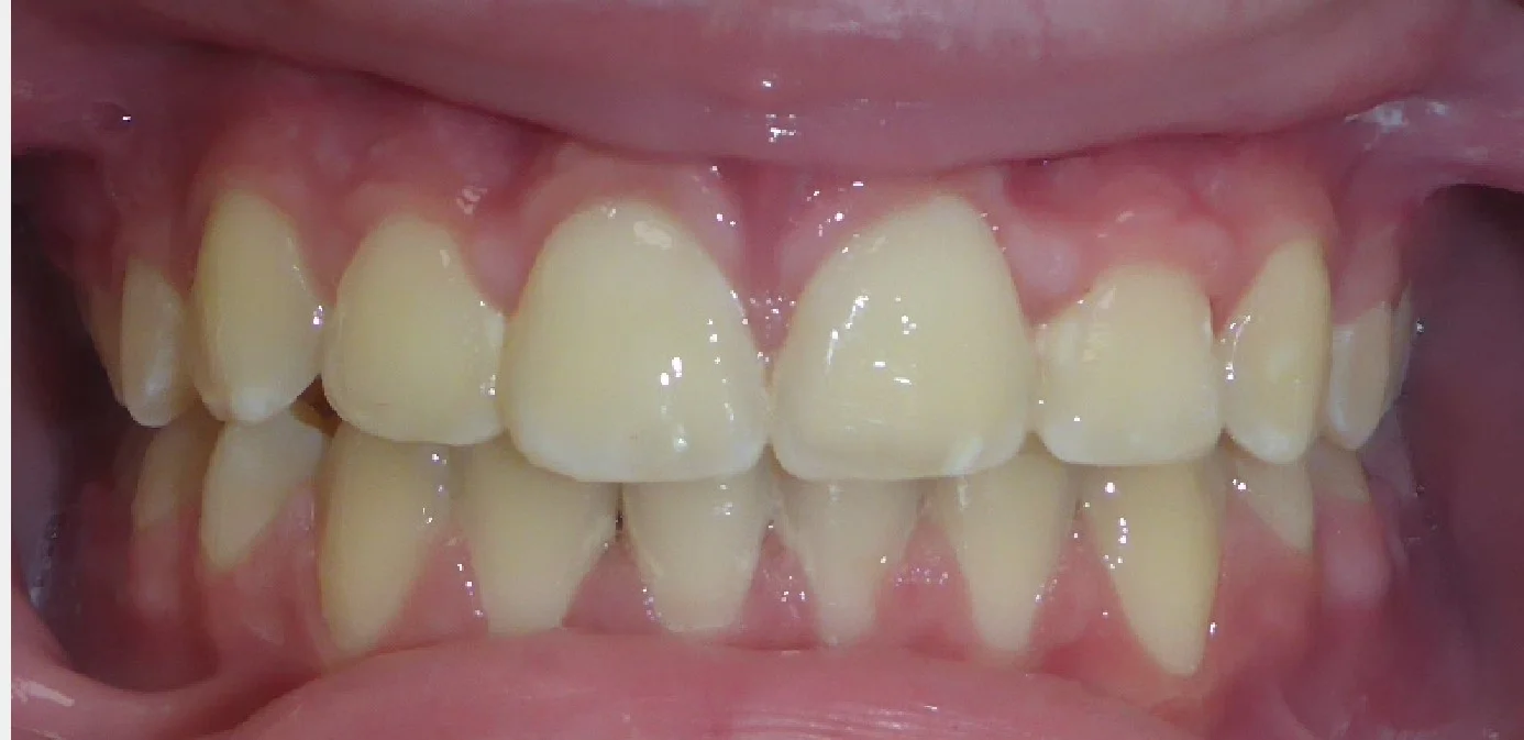 After braces treatment