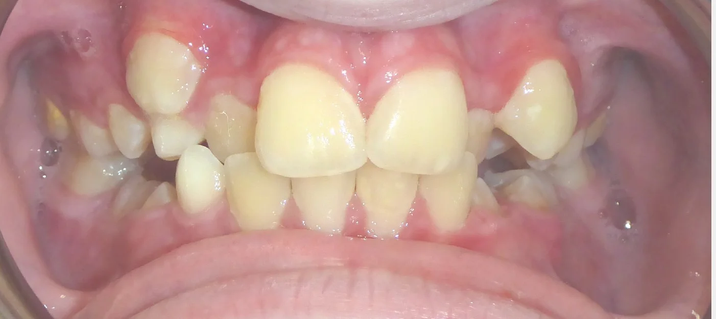 Before braces treatment