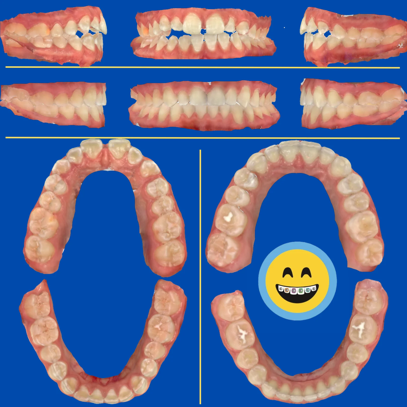 Marika - Before and After