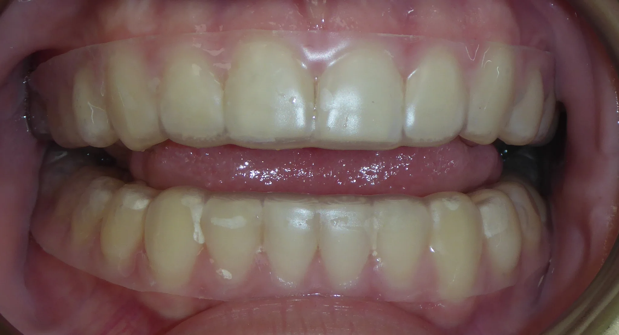 Beautiful smile with retainers