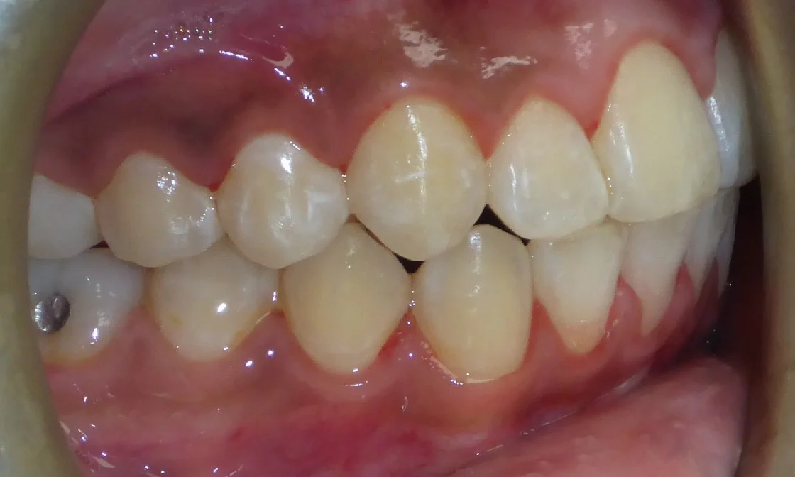 After braces treatment