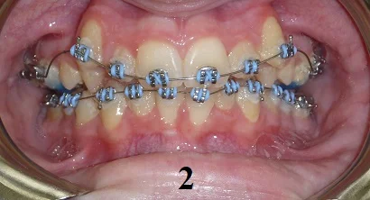 TipEdge Braces - Step 2