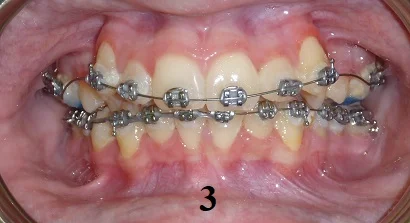 TipEdge Braces - Step 3