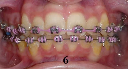 TipEdge Braces - Step 6