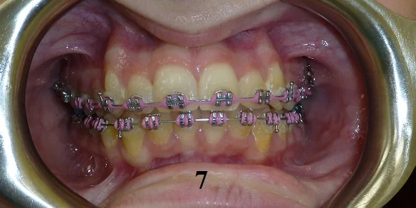 TipEdge Braces - Step 7