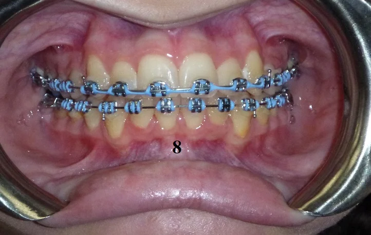 TipEdge Braces - Step 8