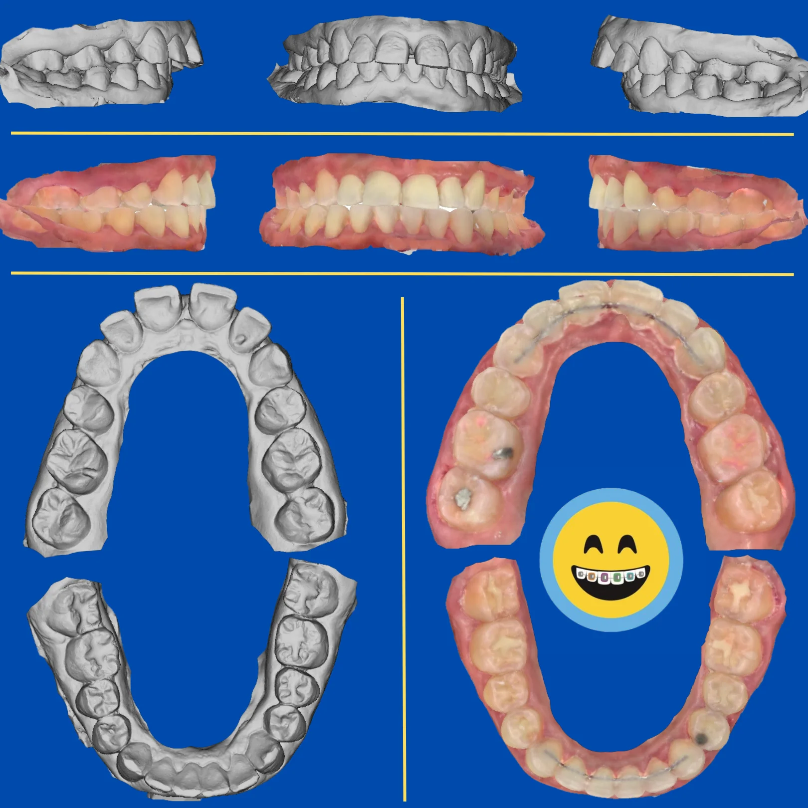 Quiros - Before and After