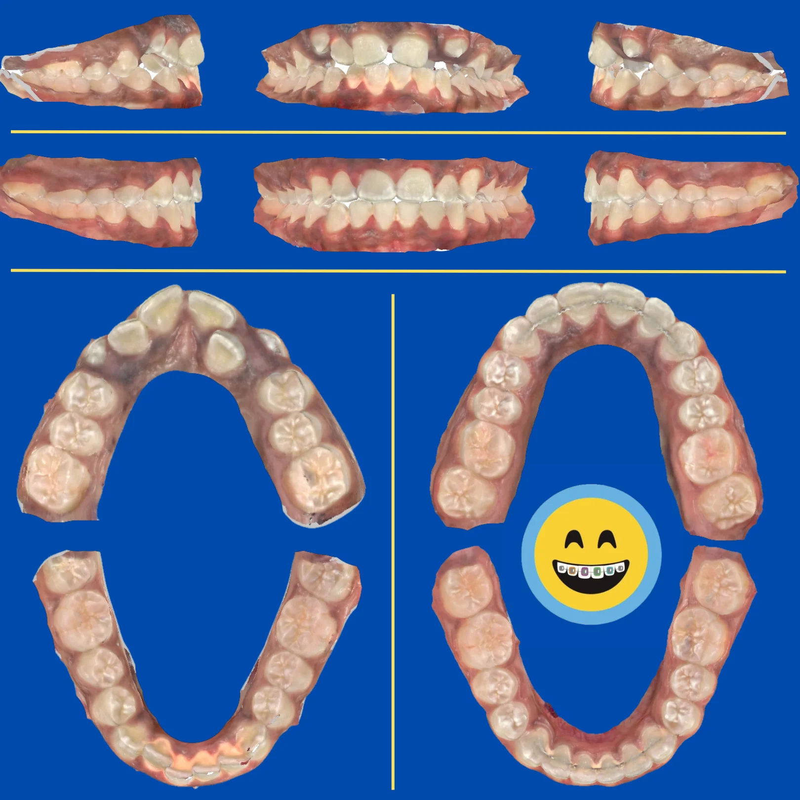 Ravon - Before and After