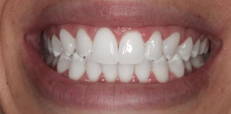 After whitening