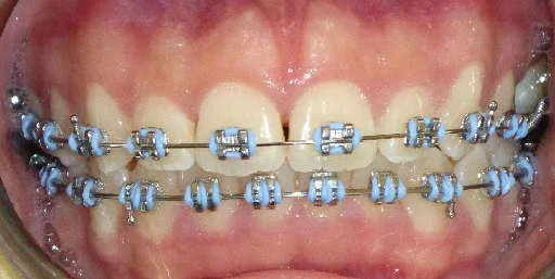 Before IPR treatment