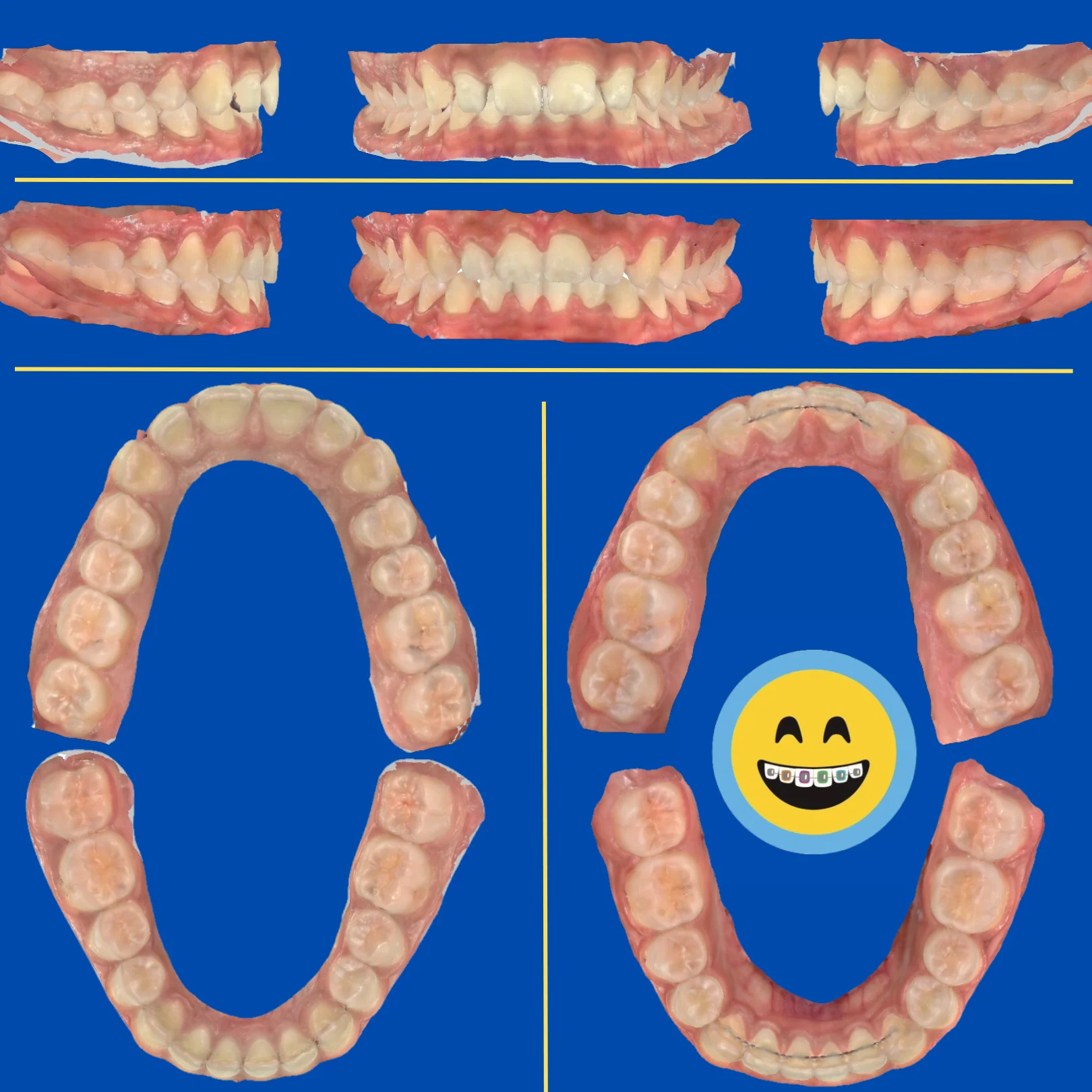 Kristal - Before and After