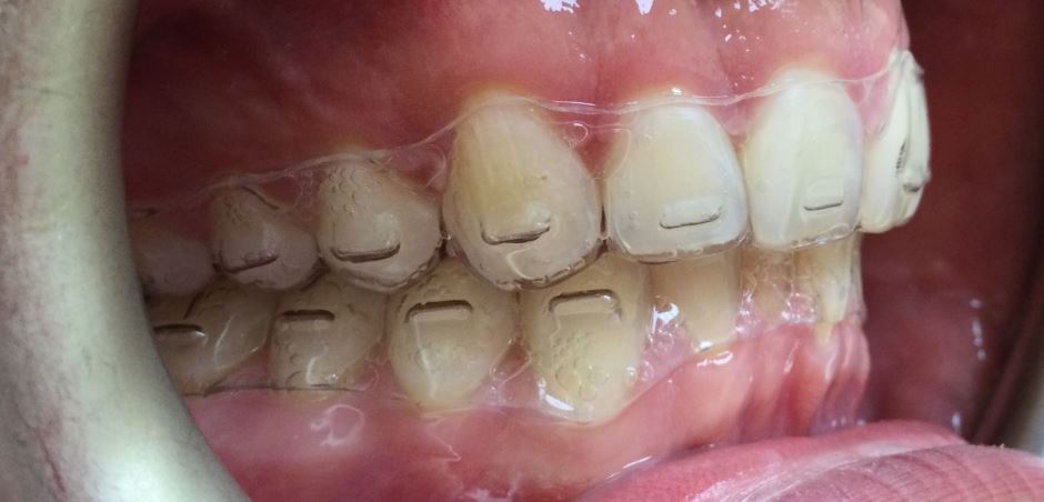Invisalign Instructions Bricks – Smile Today Orthodontics